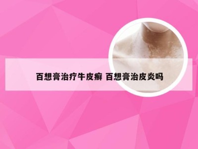 百想膏治疗牛皮癣 百想膏治皮炎吗