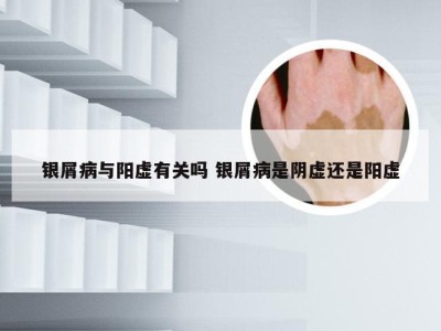 银屑病与阳虚有关吗 银屑病是阴虚还是阳虚