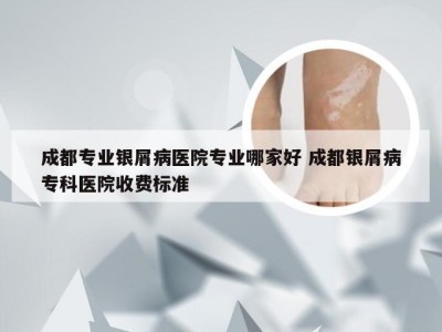 成都专业银屑病医院专业哪家好 成都银屑病专科医院收费标准