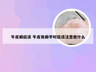 牛皮癣应该 牛皮有癣平时应该注意些什么