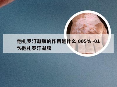 他扎罗汀凝胶的作用是什么 005%~01%他扎罗汀凝胶