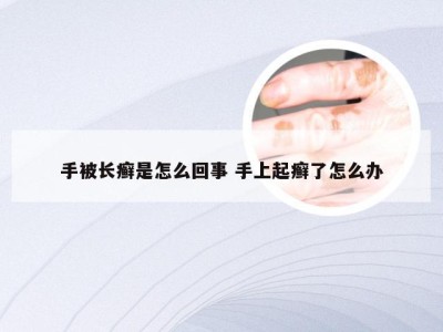 手被长癣是怎么回事 手上起癣了怎么办