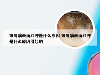 银屑病表面红肿是什么原因 银屑病表面红肿是什么原因引起的