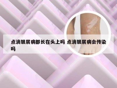 点滴银屑病都长在头上吗 点滴银屑病会传染吗