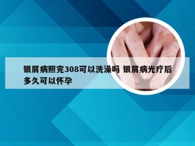 银屑病照完308可以洗澡吗 银屑病光疗后多久可以怀孕