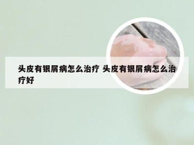 头皮有银屑病怎么治疗 头皮有银屑病怎么治疗好