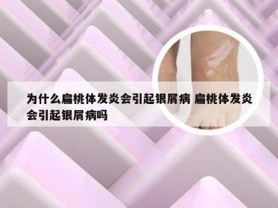 为什么扁桃体发炎会引起银屑病 扁桃体发炎会引起银屑病吗