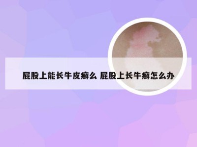 屁股上能长牛皮癣么 屁股上长牛癣怎么办