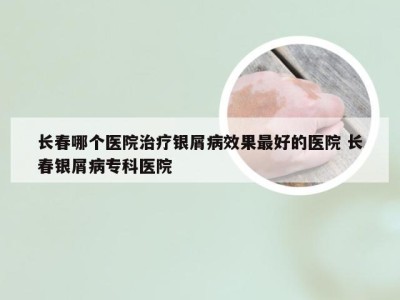 长春哪个医院治疗银屑病效果最好的医院 长春银屑病专科医院