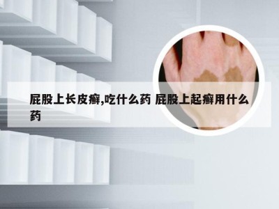 屁股上长皮癣,吃什么药 屁股上起癣用什么药