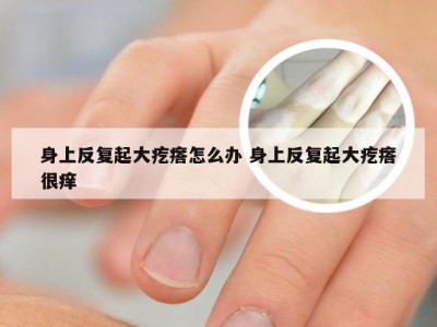 身上反复起大疙瘩怎么办 身上反复起大疙瘩很痒