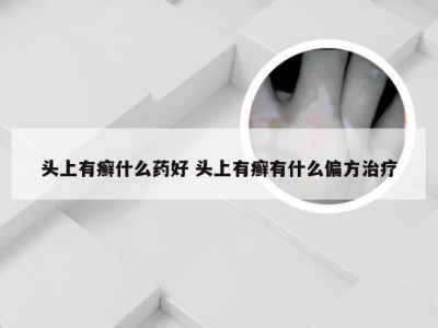 头上有癣什么药好 头上有癣有什么偏方治疗