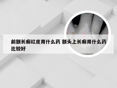 前额长癣红皮用什么药 额头上长癣用什么药比较好