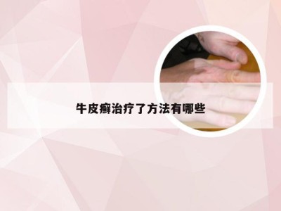 牛皮癣治疗了方法有哪些