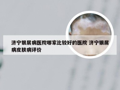 济宁银屑病医院哪家比较好的医院 济宁银屑病皮肤病评价