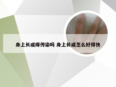 身上长戒痒传染吗 身上长戒怎么好得快