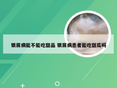 银屑病能不能吃甜品 银屑病患者能吃甜瓜吗