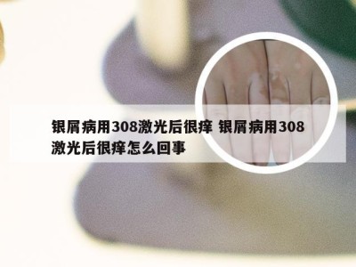 银屑病用308激光后很痒 银屑病用308激光后很痒怎么回事