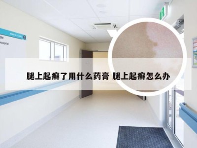 腿上起癣了用什么药膏 腿上起癣怎么办