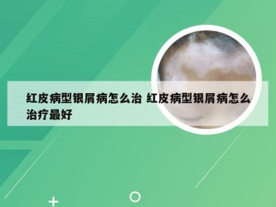 红皮病型银屑病怎么治 红皮病型银屑病怎么治疗最好