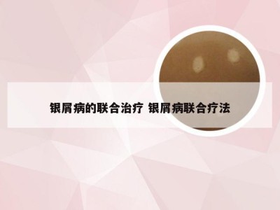 银屑病的联合治疗 银屑病联合疗法