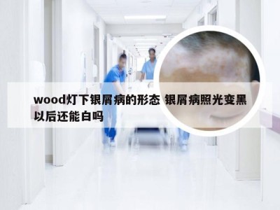 wood灯下银屑病的形态 银屑病照光变黑以后还能白吗