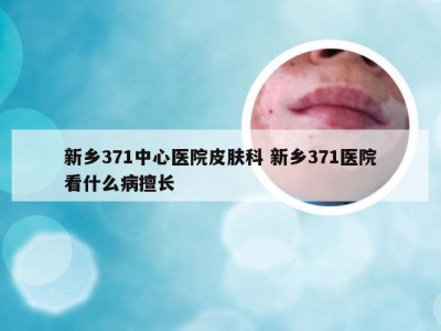 新乡371中心医院皮肤科 新乡371医院看什么病擅长