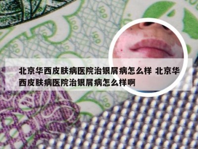 北京华西皮肤病医院治银屑病怎么样 北京华西皮肤病医院治银屑病怎么样啊