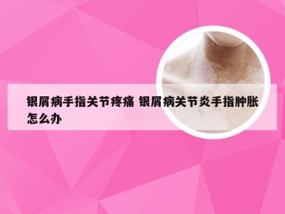 银屑病手指关节疼痛 银屑病关节炎手指肿胀怎么办