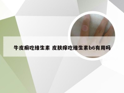 牛皮癣吃维生素 皮肤痒吃维生素b6有用吗