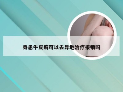 身患牛皮癣可以去异地治疗报销吗