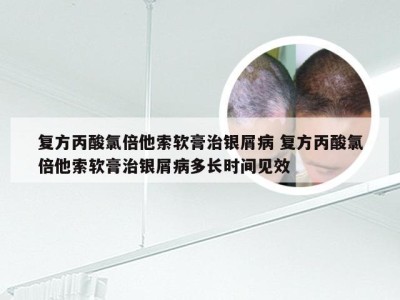 复方丙酸氯倍他索软膏治银屑病 复方丙酸氯倍他索软膏治银屑病多长时间见效