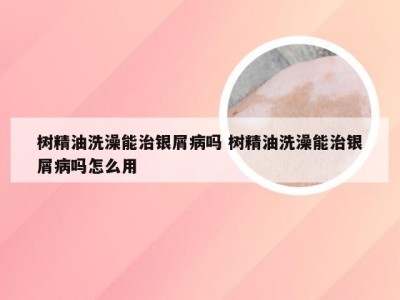 树精油洗澡能治银屑病吗 树精油洗澡能治银屑病吗怎么用