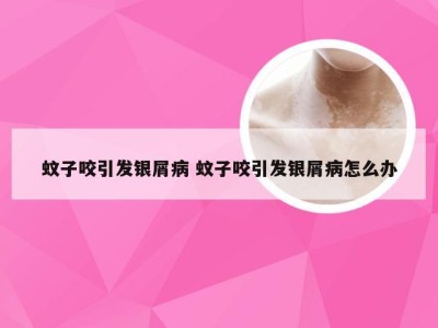 蚊子咬引发银屑病 蚊子咬引发银屑病怎么办