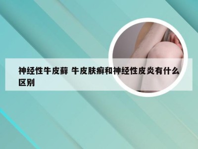 神经性牛皮藓 牛皮肤癣和神经性皮炎有什么区别