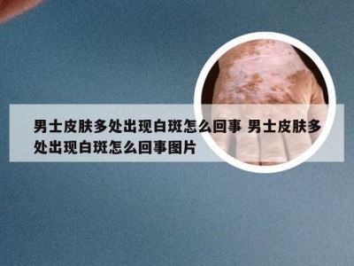 男士皮肤多处出现白斑怎么回事 男士皮肤多处出现白斑怎么回事图片