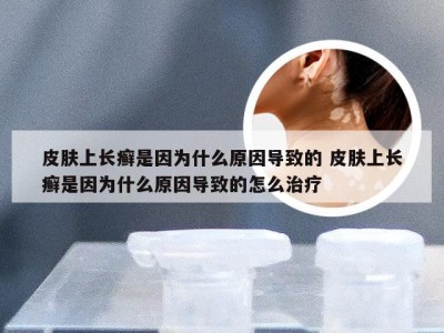 皮肤上长癣是因为什么原因导致的 皮肤上长癣是因为什么原因导致的怎么治疗