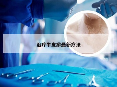 治疗牛皮癣最新疗法