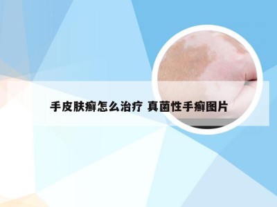 手皮肤癣怎么治疗 真菌性手癣图片