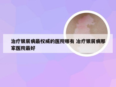 治疗银屑病最权威的医院哪有 冶疗银屑病那家医院最好