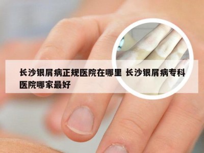 长沙银屑病正规医院在哪里 长沙银屑病专科医院哪家最好