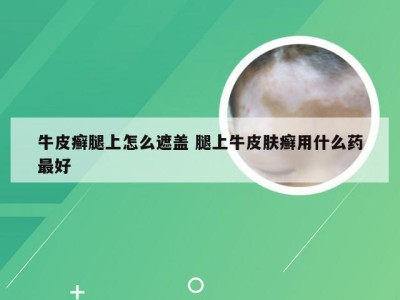 牛皮癣腿上怎么遮盖 腿上牛皮肤癣用什么药最好