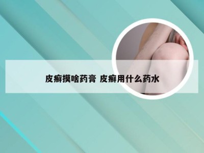 皮癣摸啥药膏 皮癣用什么药水