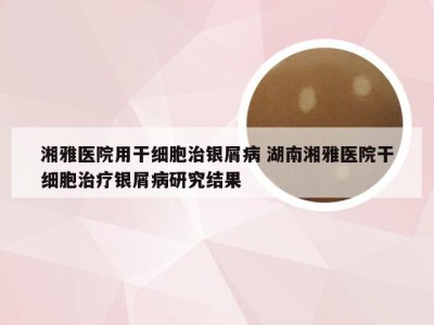 湘雅医院用干细胞治银屑病 湖南湘雅医院干细胞治疗银屑病研究结果