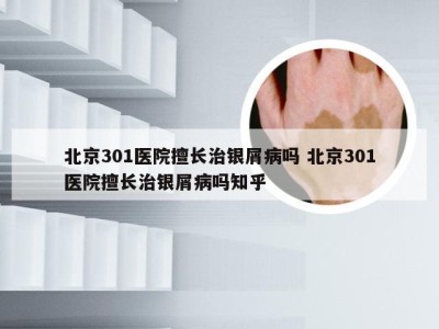 北京301医院擅长治银屑病吗 北京301医院擅长治银屑病吗知乎