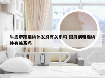 牛皮癣跟扁桃体发炎有关系吗 银屑病和扁桃体有关系吗