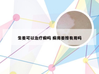 生姜可以治疗癣吗 癣用姜擦有用吗