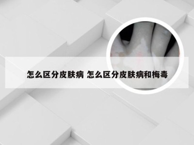 怎么区分皮肤病 怎么区分皮肤病和梅毒