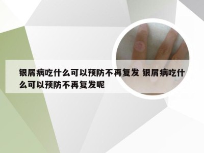 银屑病吃什么可以预防不再复发 银屑病吃什么可以预防不再复发呢