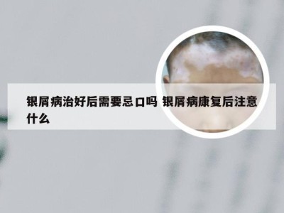 银屑病治好后需要忌口吗 银屑病康复后注意什么